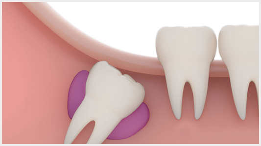 Болит зуб после пломбирования или удаления