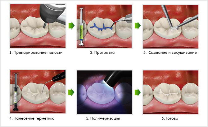 Герметизация фиссур зуба