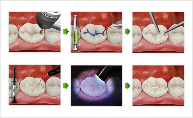 Герметизация фиссур в стоматологии