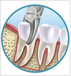 Удаление зубов в Краснодаре - стоматология Эскулап