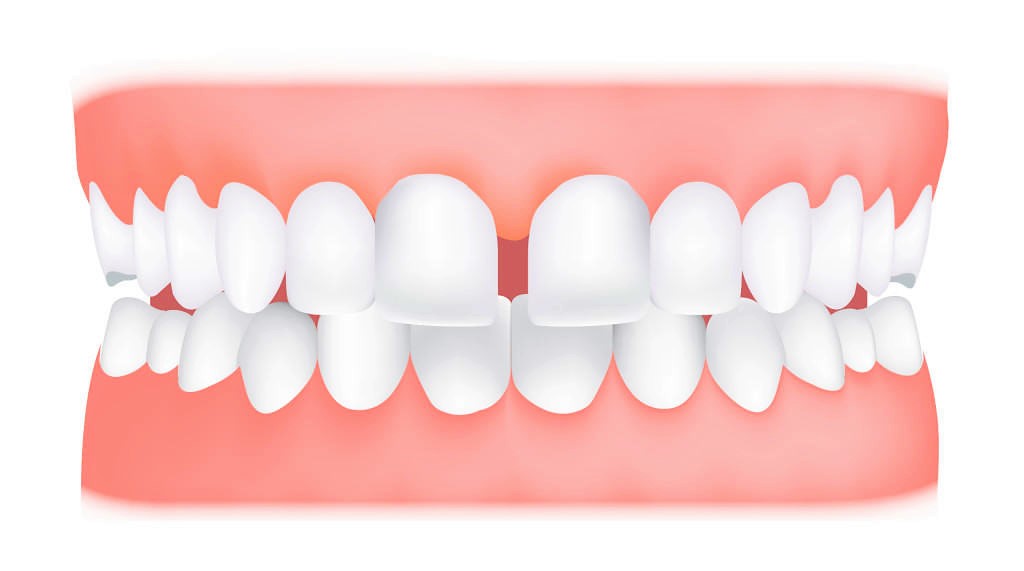 Щель между зубов – закрытие с помощью реставрации