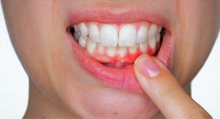 Лечение десен в стоматологии Краснодара