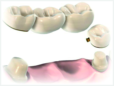 Снятие зубных коронок и протезов