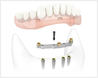 Имплантация зубов all on 4 