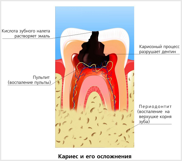 Пульпит постоянных зубов - лечение в Краснодаре
