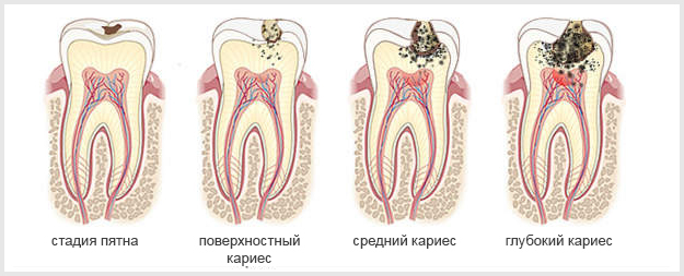 Лечение кариеса зубов в Краснодаре