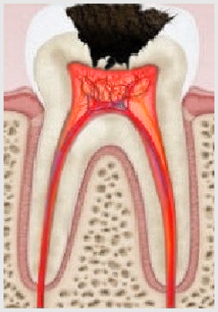 Пульпа молочного зуба.jpg