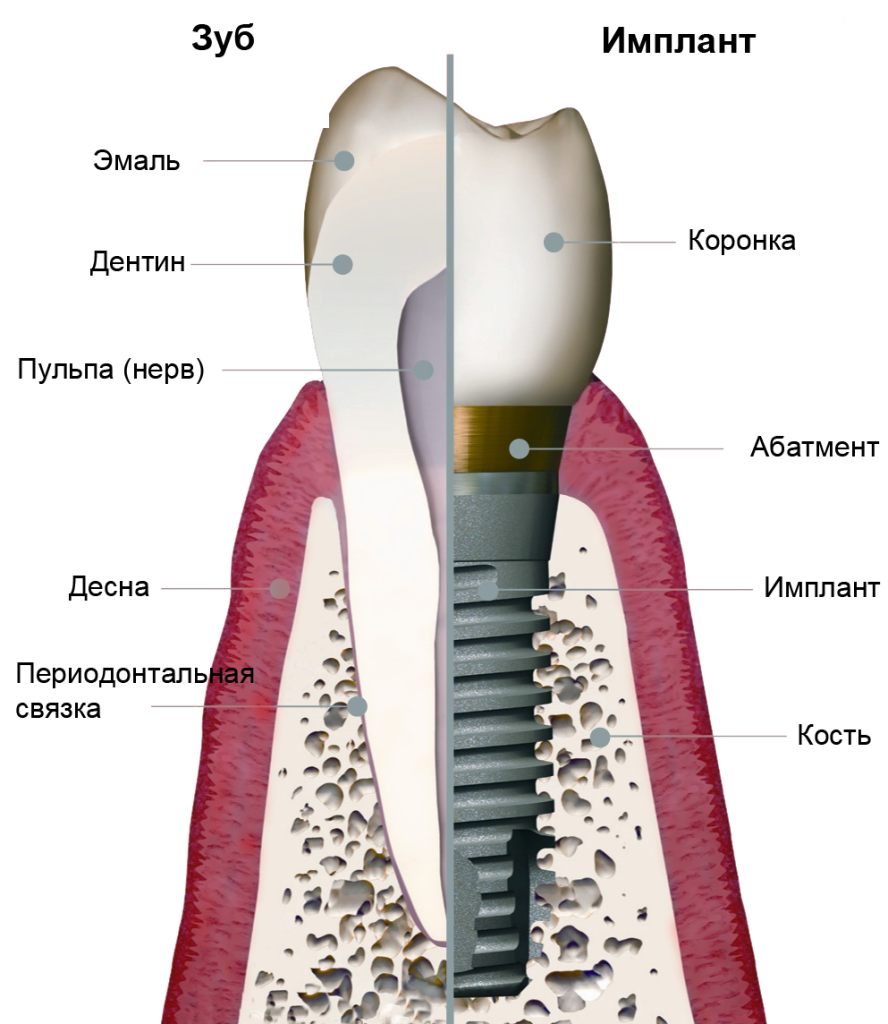 дентальная имплантация зуба