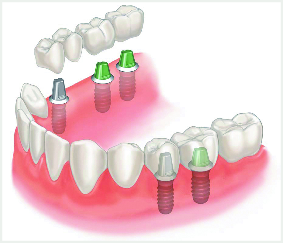 Имплантация нескольких зубов