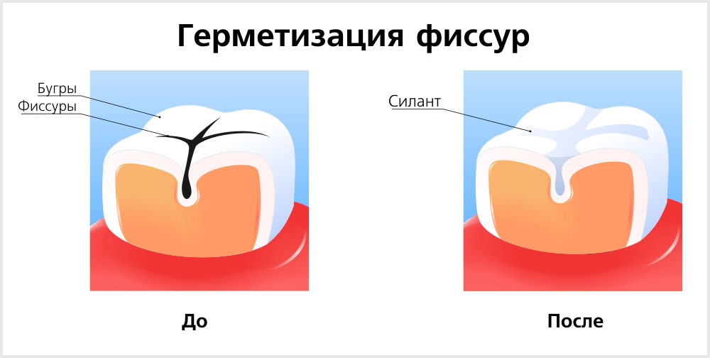 Герметизация фиссур зуба
