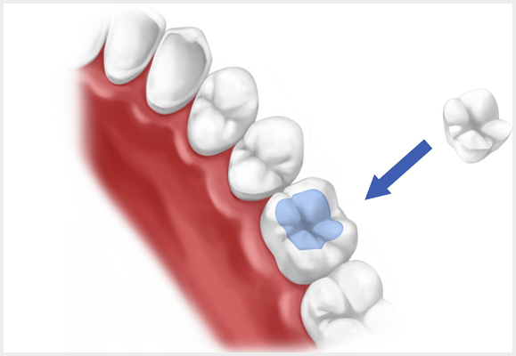 dental-fillings (1).jpg